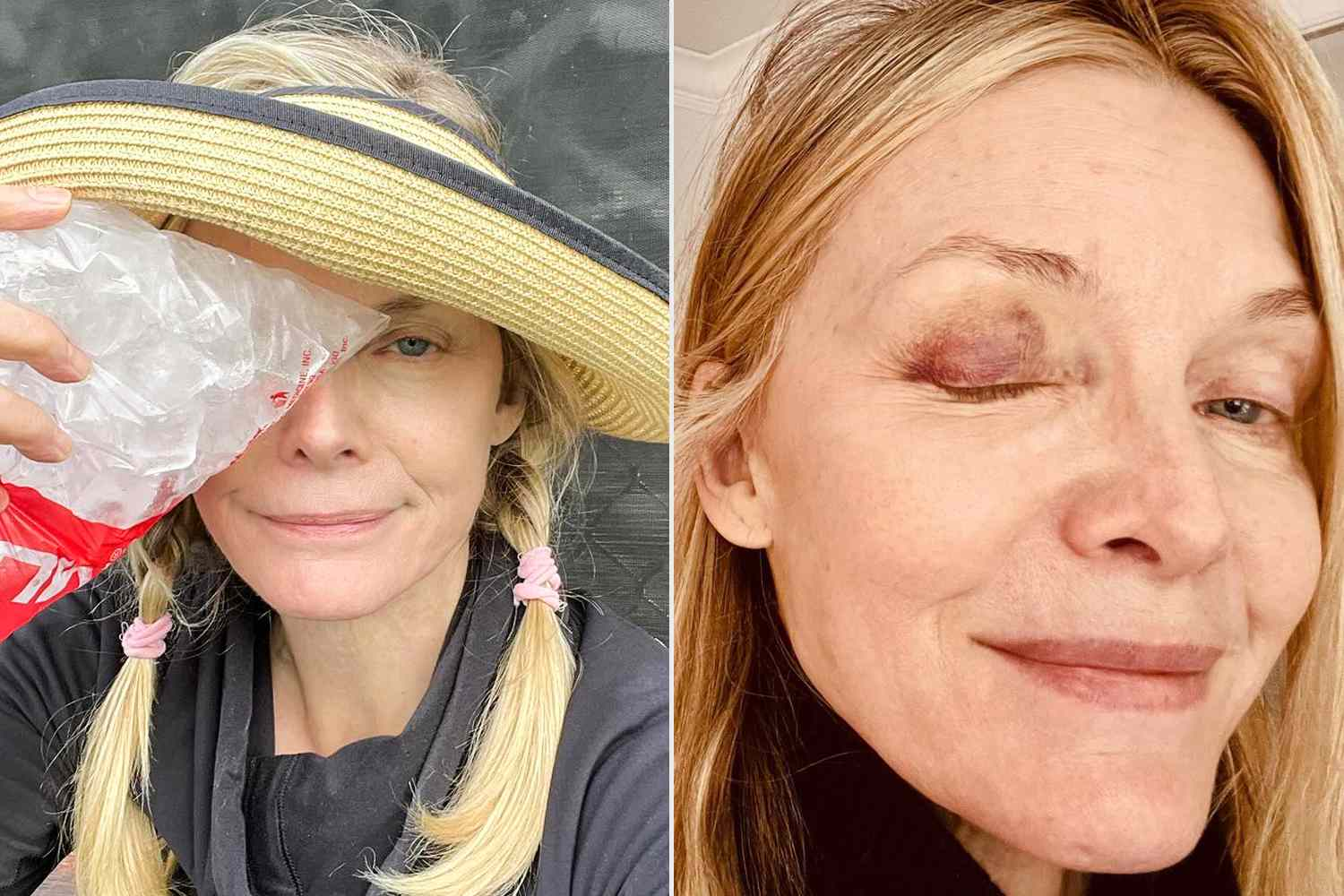 Hollywood actress Michelle Pfeiffer suffered a black eye from playing pickleball in 2023. Image Courtesy of Michelle Pfeiffer via Instagram